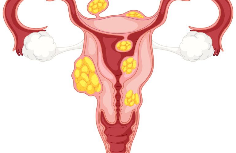 Diagram of subserosal uterine fibroids illustration